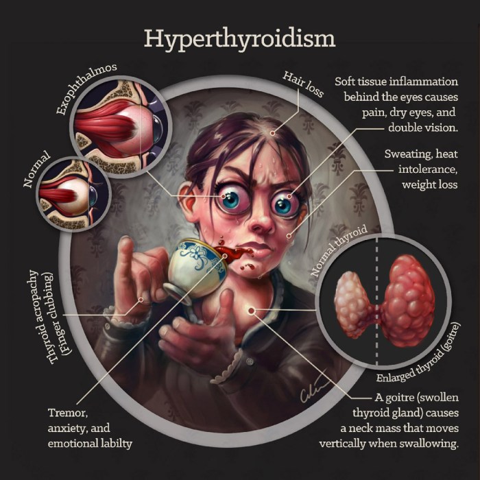 Hyperthyroidism causes and symptoms