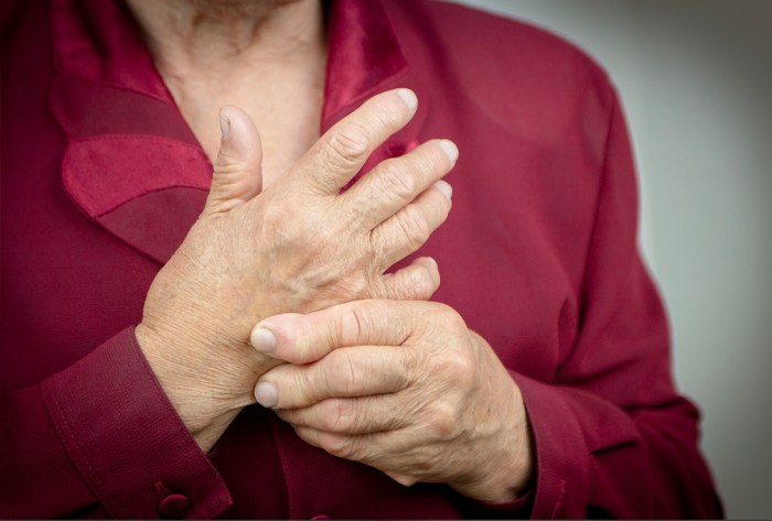 Arthritis rheumatoid symptoms hands signs early ra look healthline like article kunjungi swollen